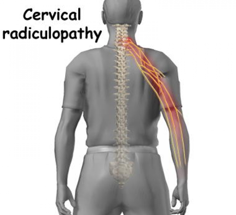 Cervical Radiculopathy Hypo Reflex Radiculopathy Cervical Radiculopathy