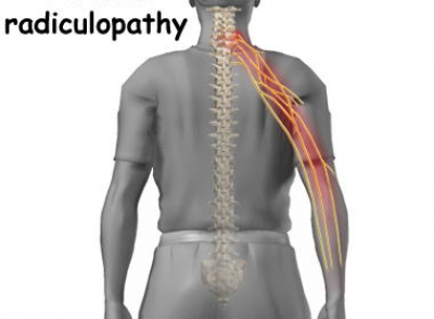 Cervical Radiculopathy