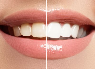 Difference Between Teeth Cleaning and Teeth Bleaching