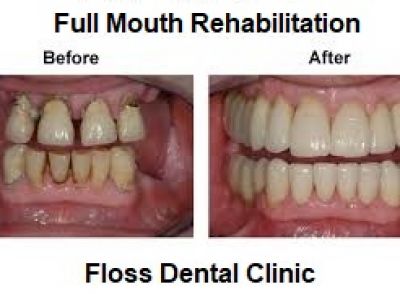 Full Mouth Rehabilitation In Noida, Delhi NCR