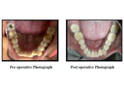 Importance of Crown after RCT