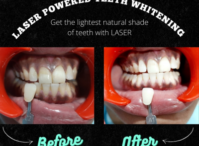 Laser Power Teeth Whitening