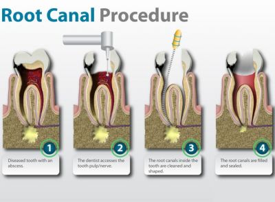 Single Sitting Root Canal Treatment