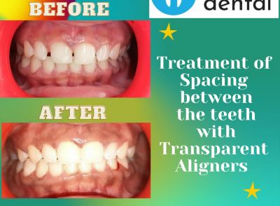 The transparent way to correct Malocclusion