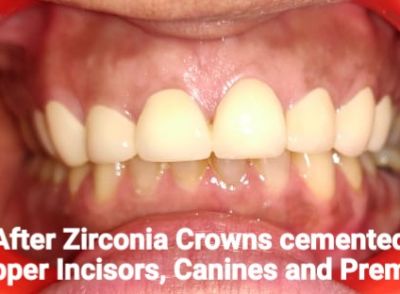 Zirconia Crowns For Perfect Smile