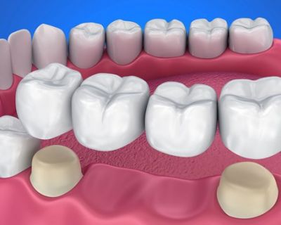 Dentures, Crowns and Bridges